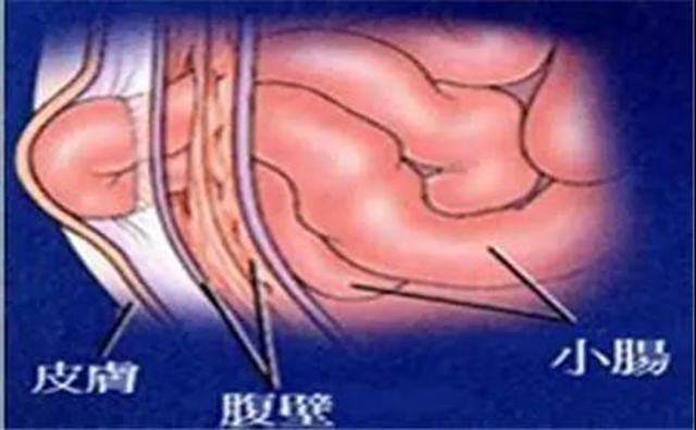 【厉害】指甲盖大小手术切口治疗疝气！(图1)