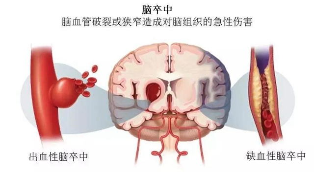 【扩散】针眼大的口子，就能检查脑血管病？(图2)