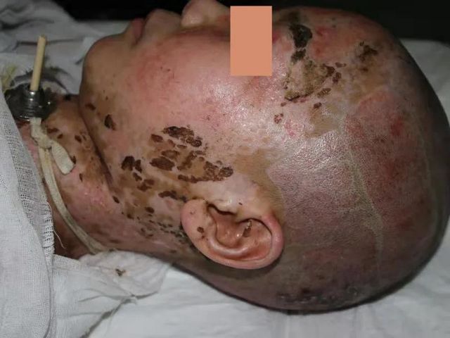 哥哥严重烧伤，7岁双胞胎弟弟捐头部皮肤不叫一声疼！(图6)