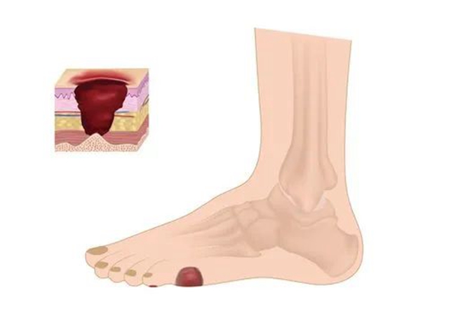 西南医大附院康健中心院区伤口造口淋巴水肿门诊开诊啦！看看哪些疾病要找它？(图5)