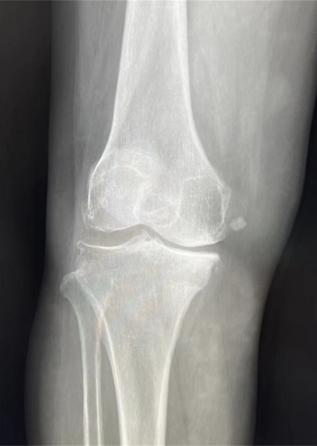 西南医大附院成功完成首例国产机器人膝关节置换辅助手术(图2) 西南医大附院成功完成首例国产机器人膝关节置换辅助手术(图2)