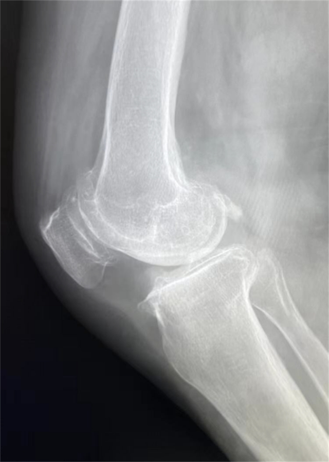西南医大附院成功完成首例国产机器人膝关节置换辅助手术(图3) 西南医大附院成功完成首例国产机器人膝关节置换辅助手术(图3)