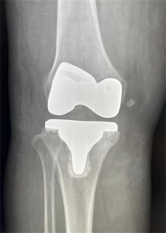 西南医大附院成功完成首例国产机器人膝关节置换辅助手术(图4) 西南医大附院成功完成首例国产机器人膝关节置换辅助手术(图4)