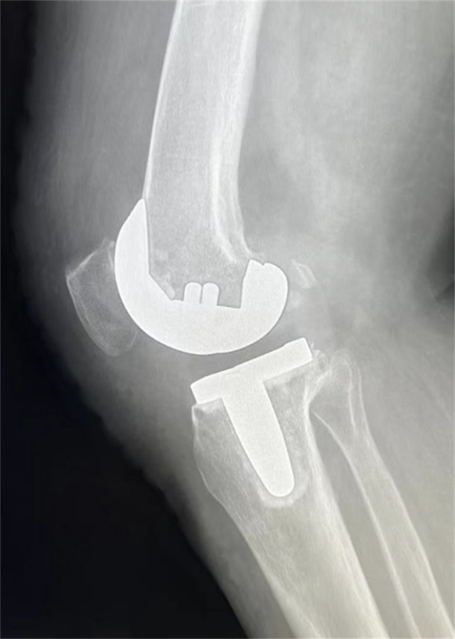 西南医大附院成功完成首例国产机器人膝关节置换辅助手术(图5) 西南医大附院成功完成首例国产机器人膝关节置换辅助手术(图5)