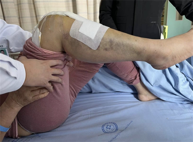 西南医大附院成功完成首例国产机器人膝关节置换辅助手术(图6) 西南医大附院成功完成首例国产机器人膝关节置换辅助手术(图6)