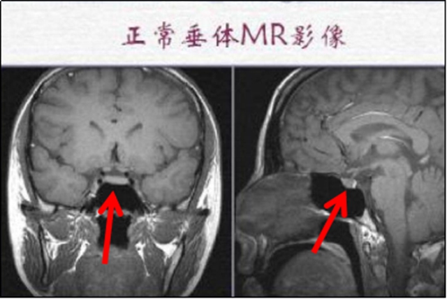 【扩散】孩子长太高？警惕脑子出问题！(图3)