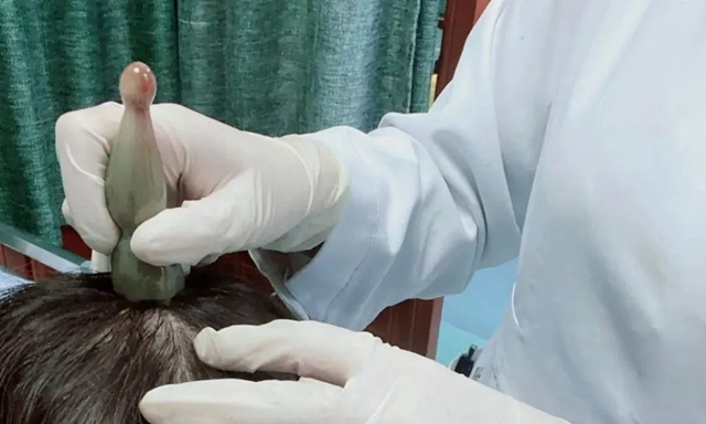 头发渐渐消失！给你1个治法(图4)