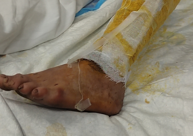 毒蛇提前“出关”，泸州两人被咬(图2)