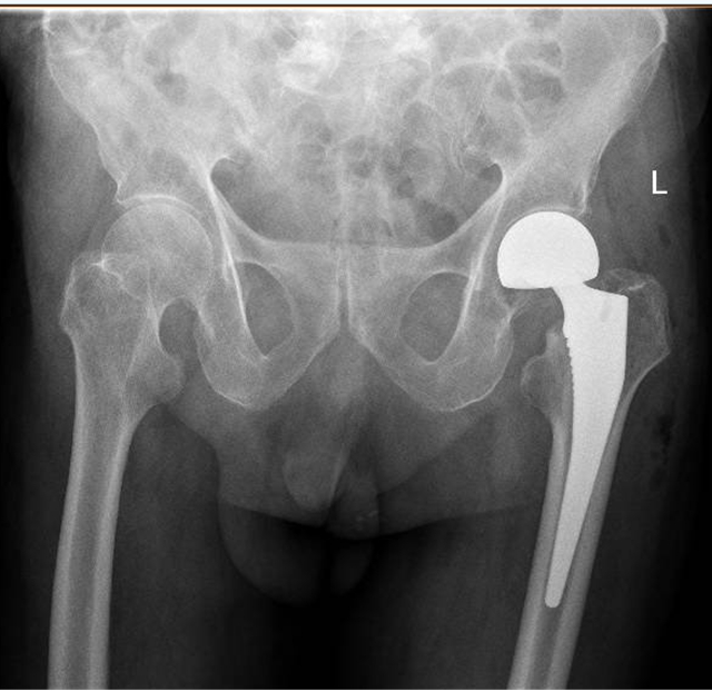 泸州市中医医院为102岁老人成功完成髋关节骨折手术(图4)