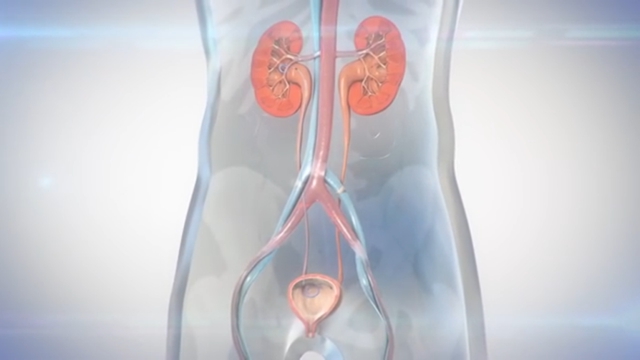 【关注】宜宾一男子遭了，输尿管里安支架！(图2)