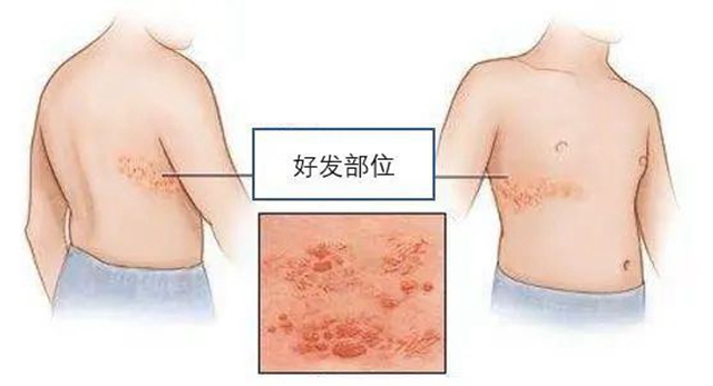 “蛇缠腰”可通过打疫苗预防，赶紧带父母去打(图3)