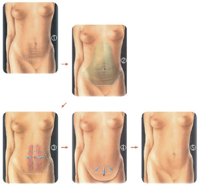 【围观】想要小腹变平坦?原来还可以这样(图3) 【围观】想要小腹变平坦?原来还可以这样(图3)