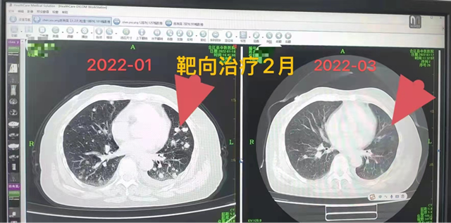 【科普】开启肺癌肿瘤治疗新时代——靶向和免疫治疗(图3)