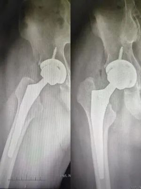 好消息！降价近九成，西南医大附院人工关节正式告别“万元”时代！(图2)