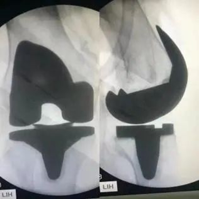 好消息！降价近九成，西南医大附院人工关节正式告别“万元”时代！(图4)