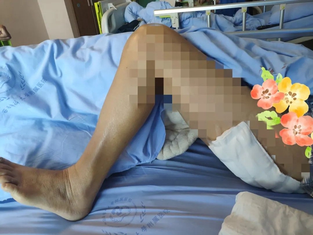 好消息！降价近九成，西南医大附院人工关节正式告别“万元”时代！(图6)