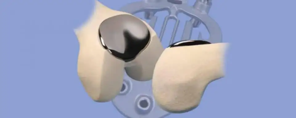 【好消息】关节炎患者注意，费用直降3万多元……