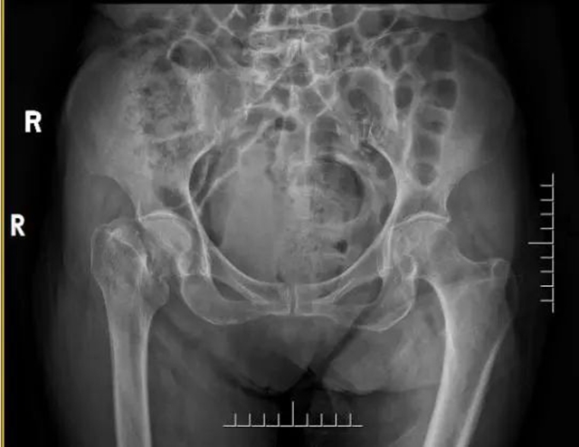 105岁婆婆摔倒骨折,第二天竟重新站起来了!(图2) 2.jpg