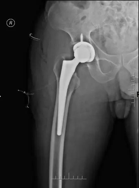 105岁婆婆摔倒骨折,第二天竟重新站起来了!(图8) 8.jpg