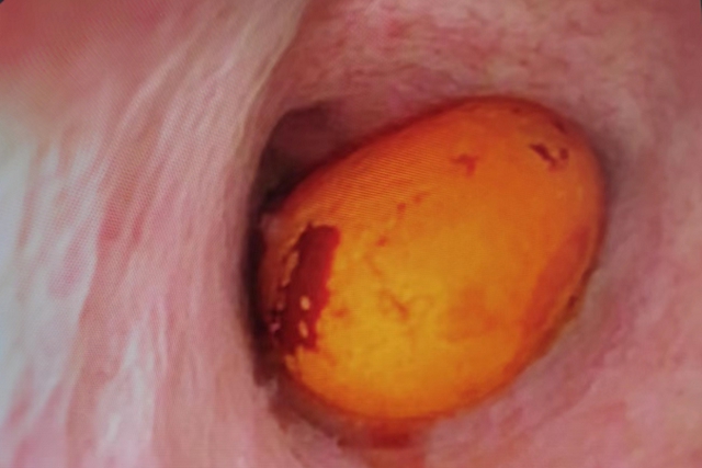 【关注】老是恶心打嗝，竟是胆里长了石头！