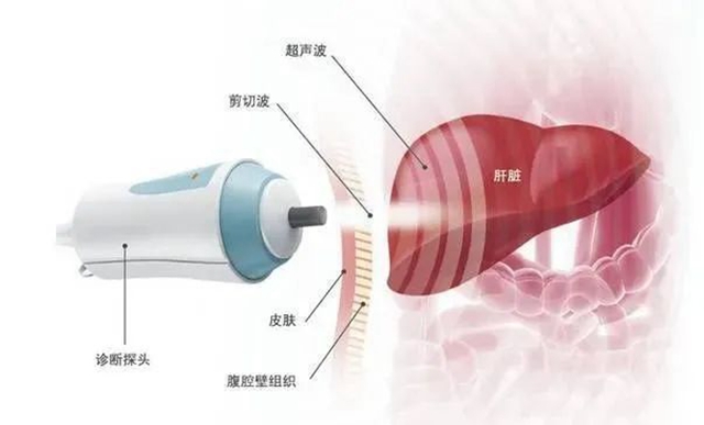 您的肝还好吗？教您一分钟看懂您的“肝弹性检查报告”