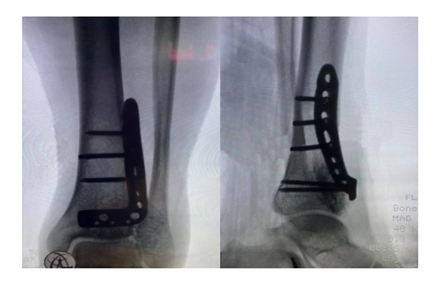 【扩散】男子患骨肿瘤,差点截肢?(图3) 3-1.jpg