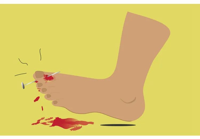 【警惕】男子“加料”泡脚,致截趾!(图5) 5.jpg