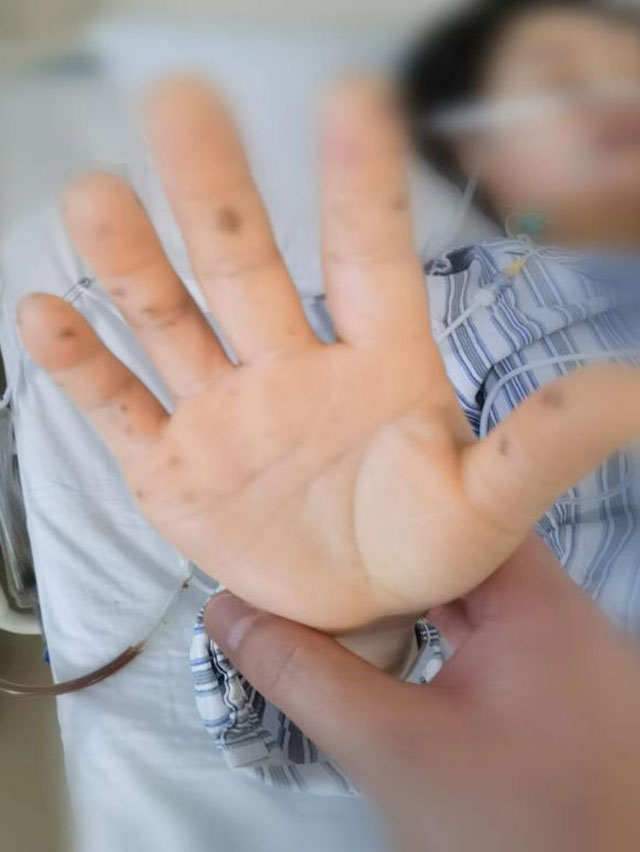 嘴上、手上长黑斑，女子被查出癌变……