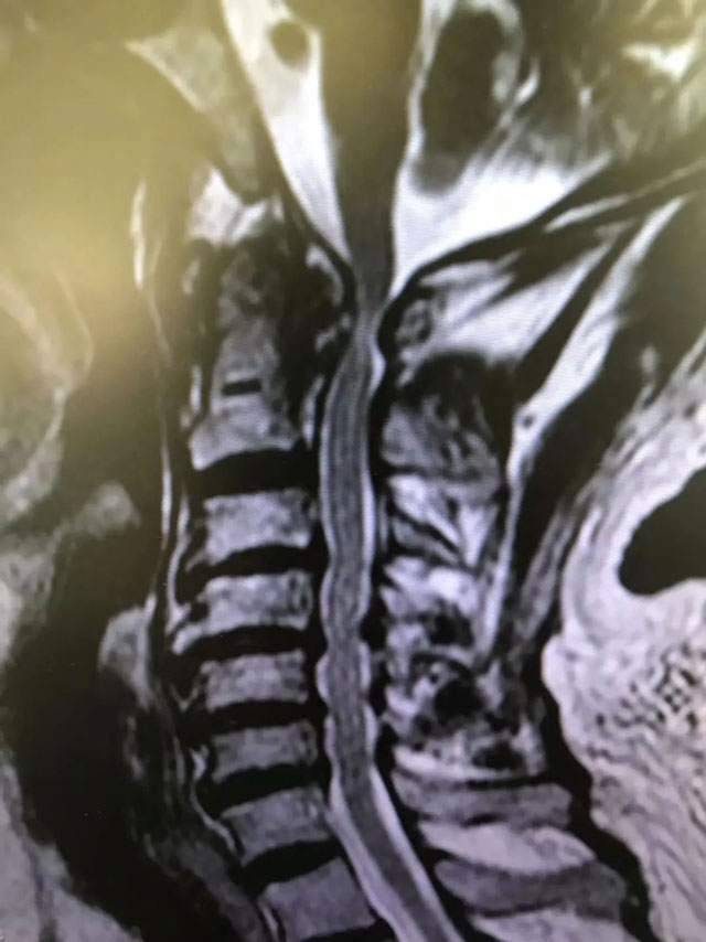在生命中枢“动刀”挽救患者 西南医大附院脊柱外科王清教授团队完成罕见手术！