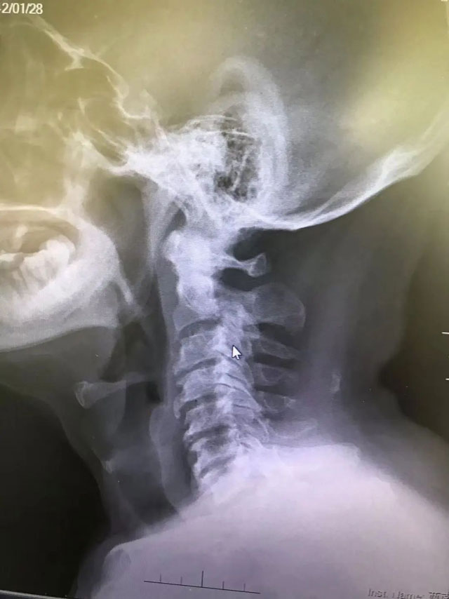 在生命中枢“动刀”挽救患者 西南医大附院脊柱外科王清教授团队完成罕见手术!(图2) 2-1.jpg