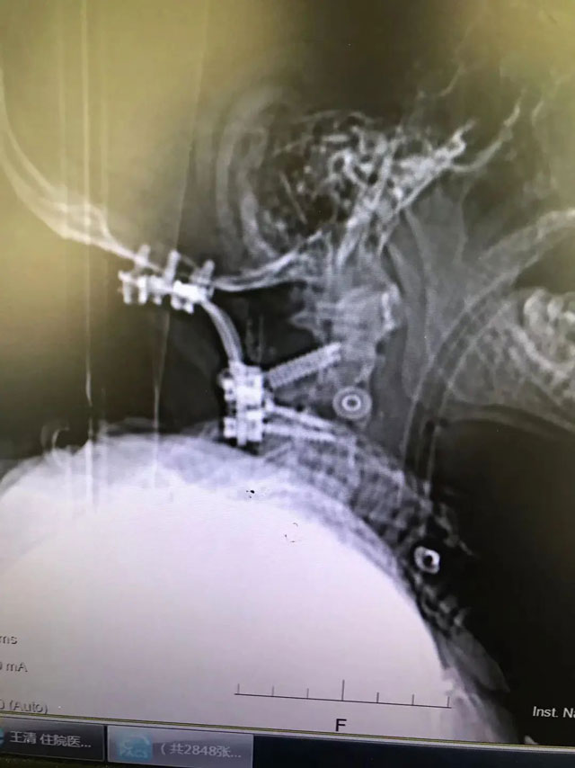 在生命中枢“动刀”挽救患者 西南医大附院脊柱外科王清教授团队完成罕见手术!(图3) 3-1.jpg