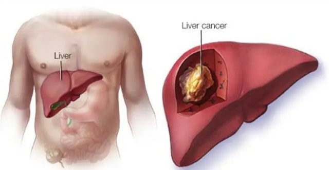 【关注】男子患肝癌，可免费治疗一年！