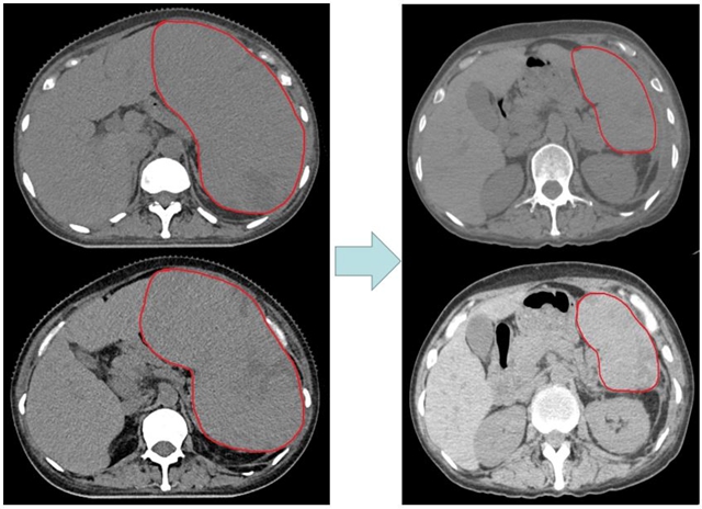 【罕见】女子肚大如10月孕妇,竟是……(图3) 孕妇3.jpg