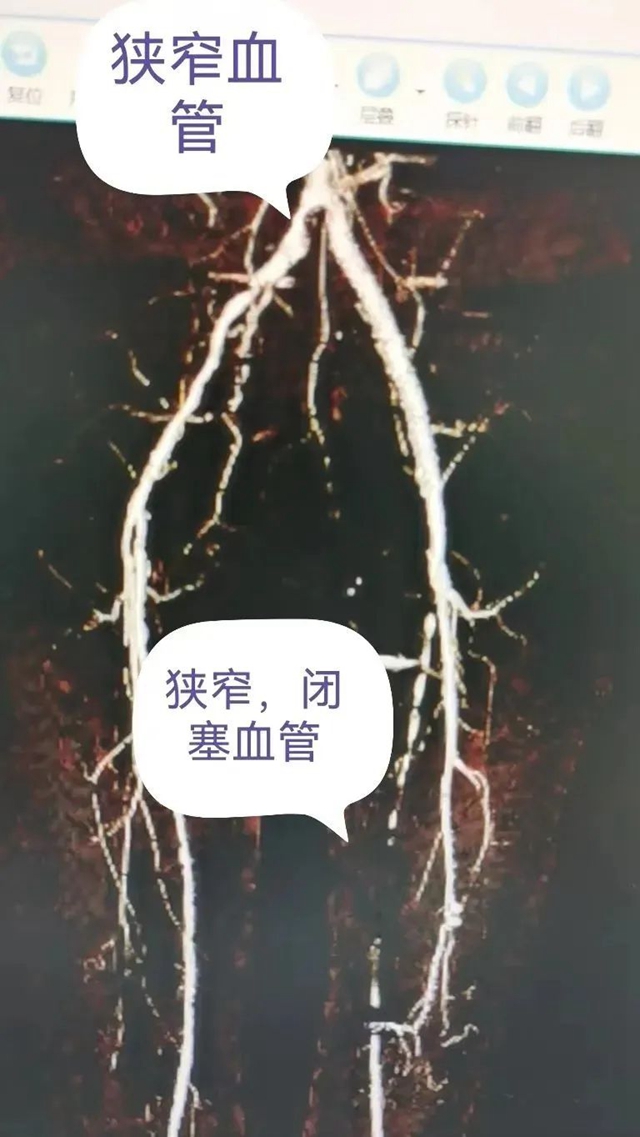 【医疗技术】介入治疗显神效——合江县中医医院成功完成一例下肢动脉闭塞开通手术(图2) 血2.jpg