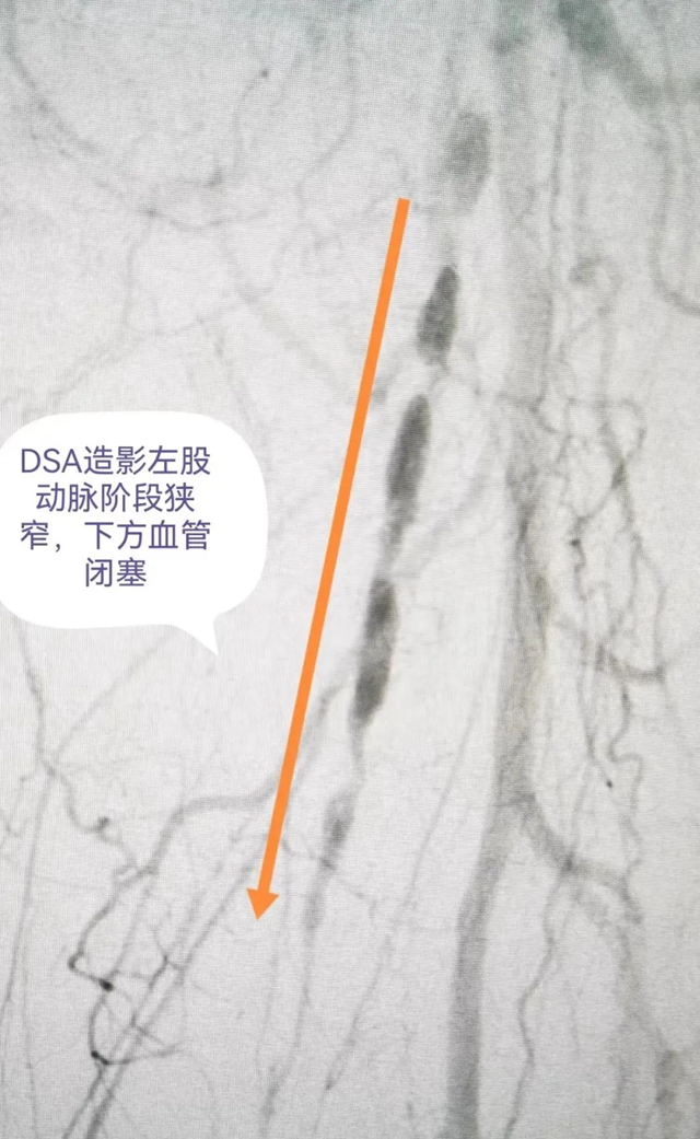 【医疗技术】介入治疗显神效——合江县中医医院成功完成一例下肢动脉闭塞开通手术(图3) 血3.jpg