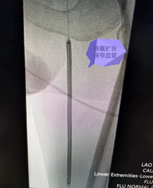 【医疗技术】介入治疗显神效——合江县中医医院成功完成一例下肢动脉闭塞开通手术(图4) 血4.jpg