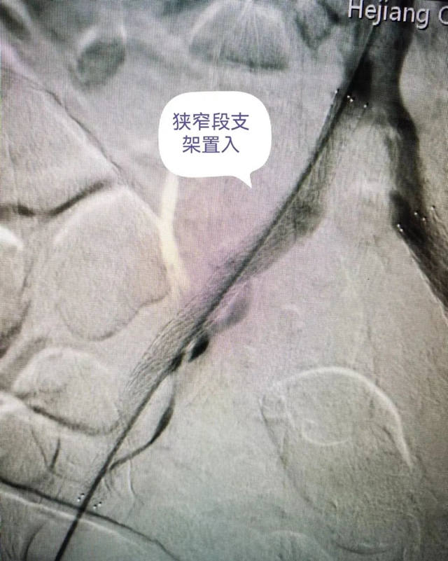 【医疗技术】介入治疗显神效——合江县中医医院成功完成一例下肢动脉闭塞开通手术(图5) 血5.jpg