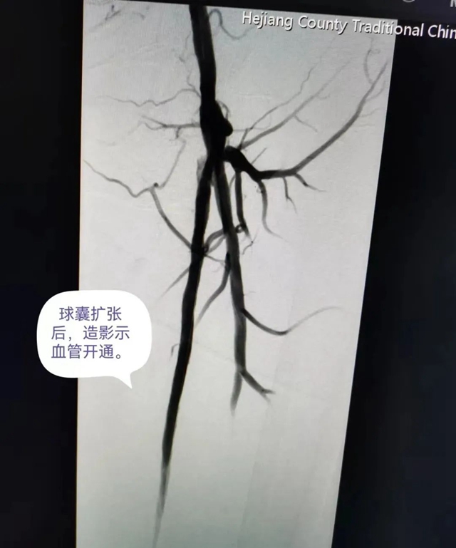 【医疗技术】介入治疗显神效——合江县中医医院成功完成一例下肢动脉闭塞开通手术(图6) 血6.jpg