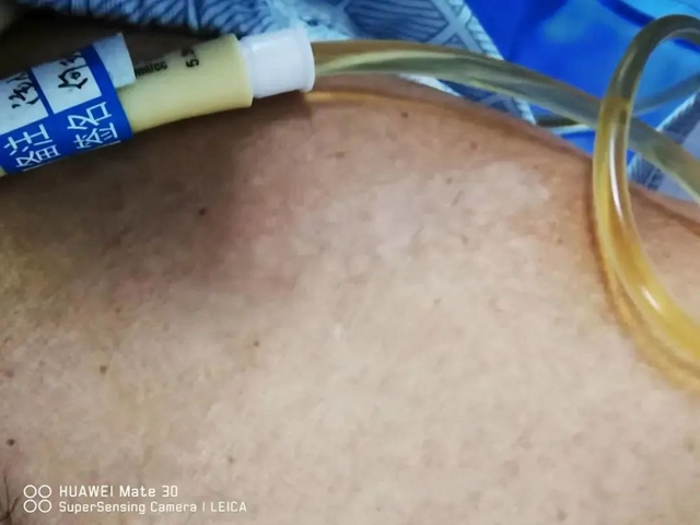 【医疗技术】介入治疗显神效——合江县中医医院成功完成一例下肢动脉闭塞开通手术(图7) 血7.jpg