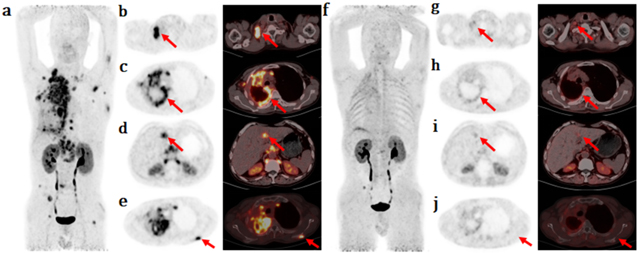 肿瘤治疗——核药再突破！