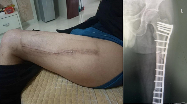 【围观】断手断脚？古法技术有特效！