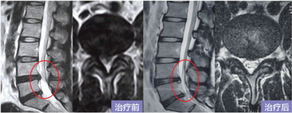【扩散】泸州女子腰疼7年,竟是……(图6) 6.png
