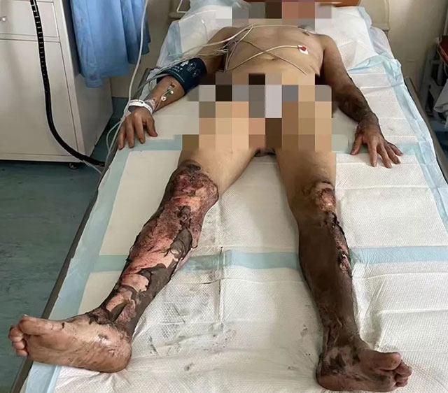 【关注】27名烧烫伤患者“去腐生新”的日子(图1) 1.jpg