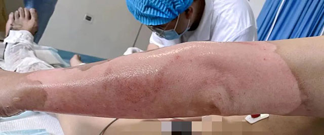 【关注】27名烧烫伤患者“去腐生新”的日子(图3) 3.jpg