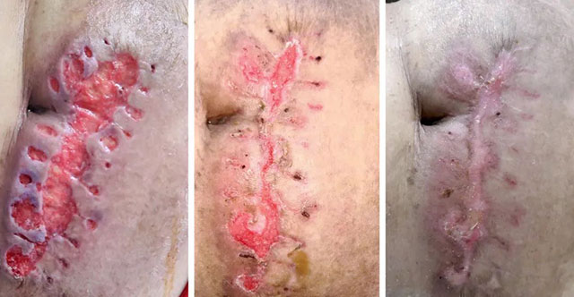 【关注】27名烧烫伤患者“去腐生新”的日子(图4) 4.jpg