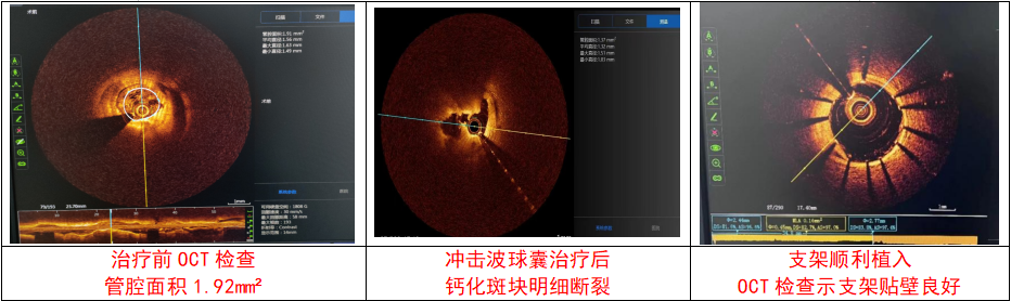 【围观】血管里长结石!动脉被堵……(图3) 3.png