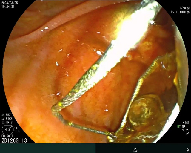 【扩散】不开刀就可以取结石?(图2) 2.jpg