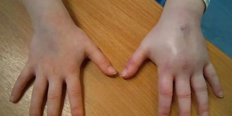 【注意】身上一按一个坑,很多人忽略这个病……(图7) 7.jpg