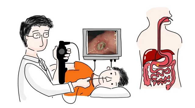 【警惕】胃里长的“小肉肉”，竟是癌