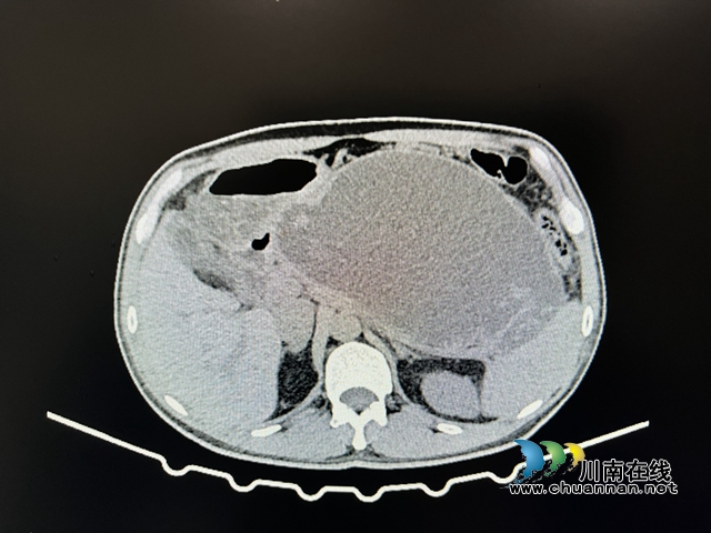 【吓人】男子突感腹痛、腹胀，竟查出西瓜大小的……